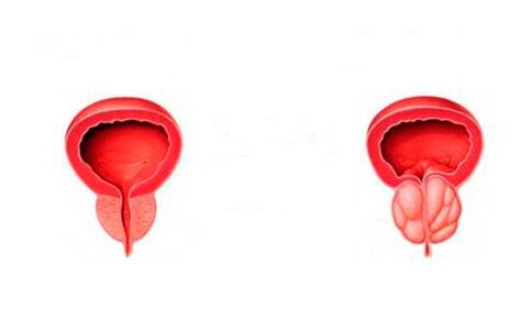 prostate saine et enflammée avec prostatite