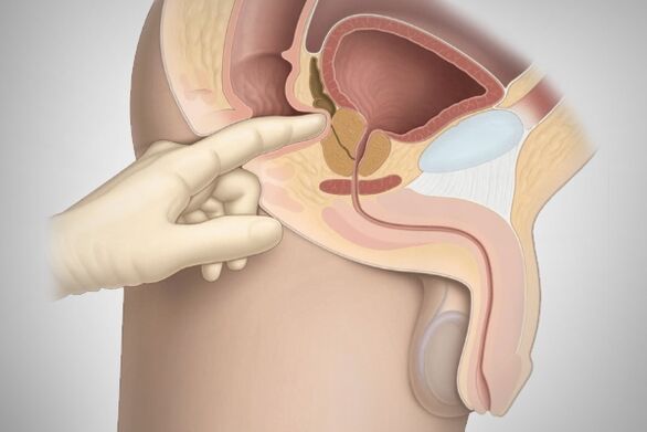 Massage de la prostate pour la prostatite bactérienne