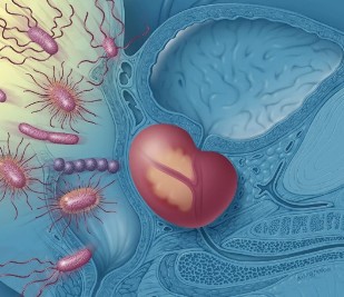 L'inflammation de la prostate